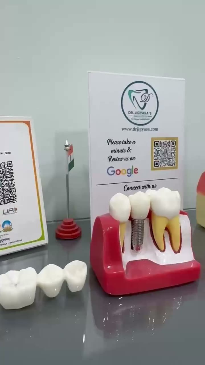 Dental implant model at the clinic