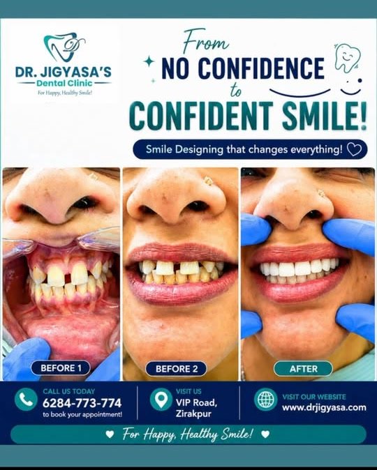 Before and after smile designing