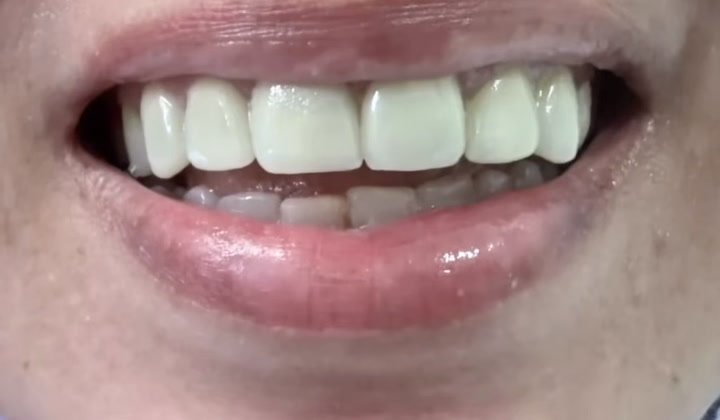Smile makeover with veneers
